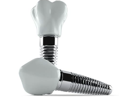 어금니 임플란트 가격