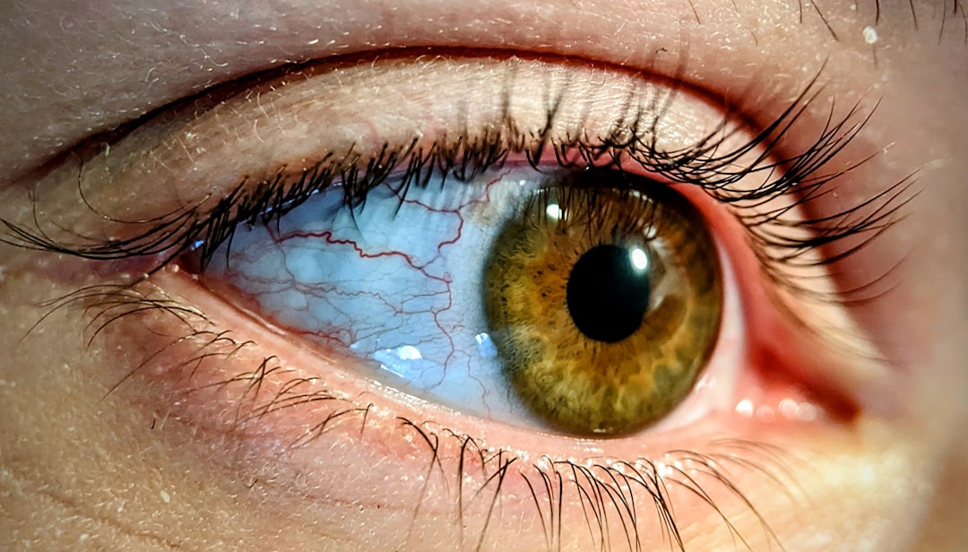 Cataract
