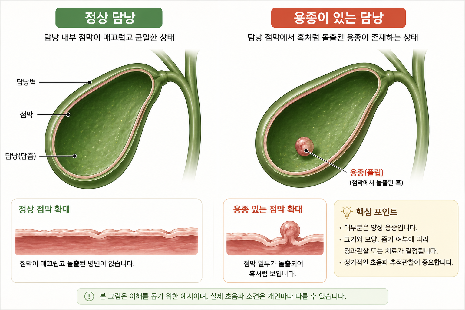 담낭용종 크기별 위험도 정리