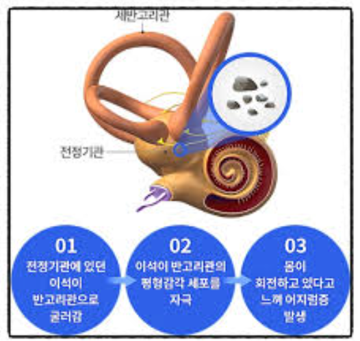 이석증 증상과 자가치료법