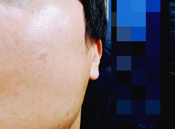 얼굴-볼에-생성된-점