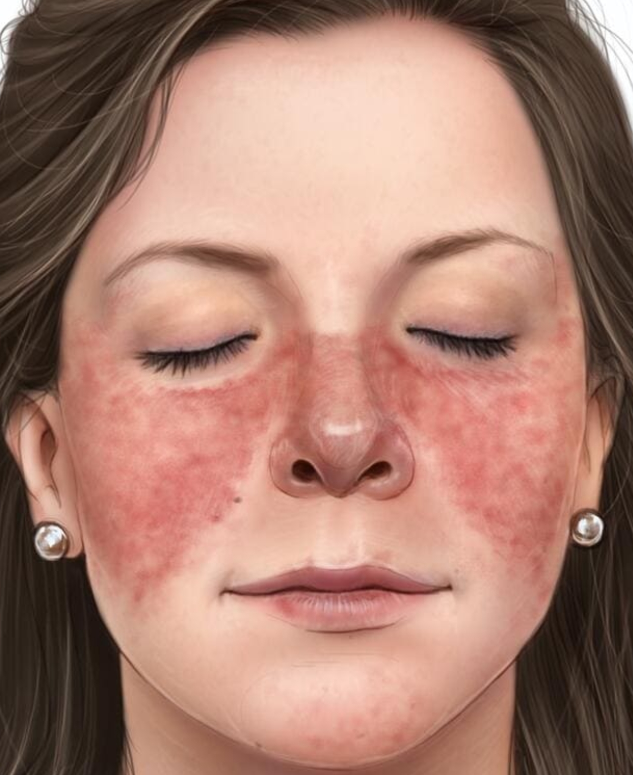 코와 볼에 나비모양 피부발진 여성