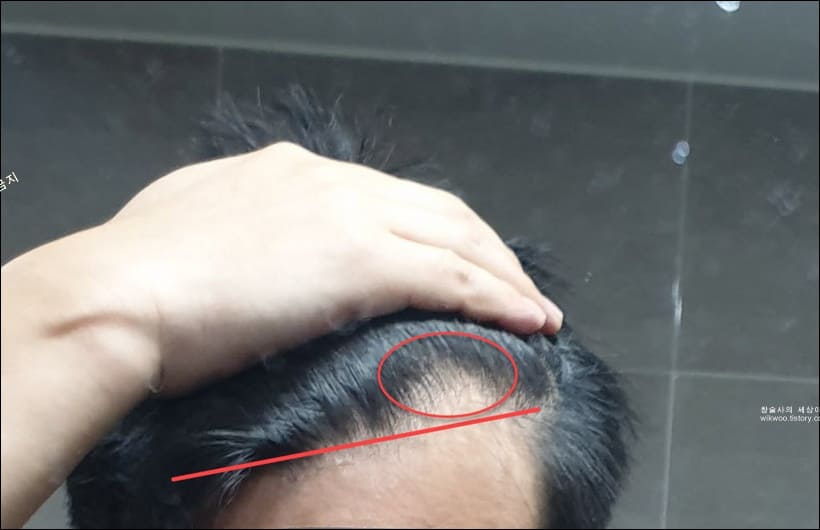 m자 탈모