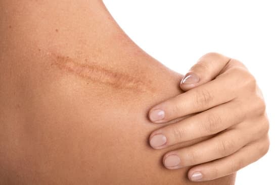 비후성 반흔(Hypertrophic Scars): 원인과 관리 방법