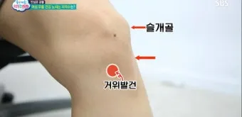 거위발 건염 원인과 증상 무릎 안쪽 통증 치료법 정리_20