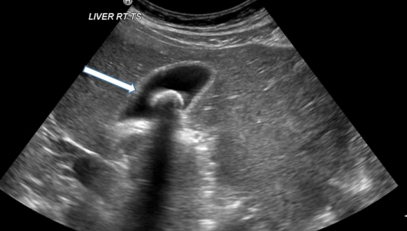 위 담적 치료방법