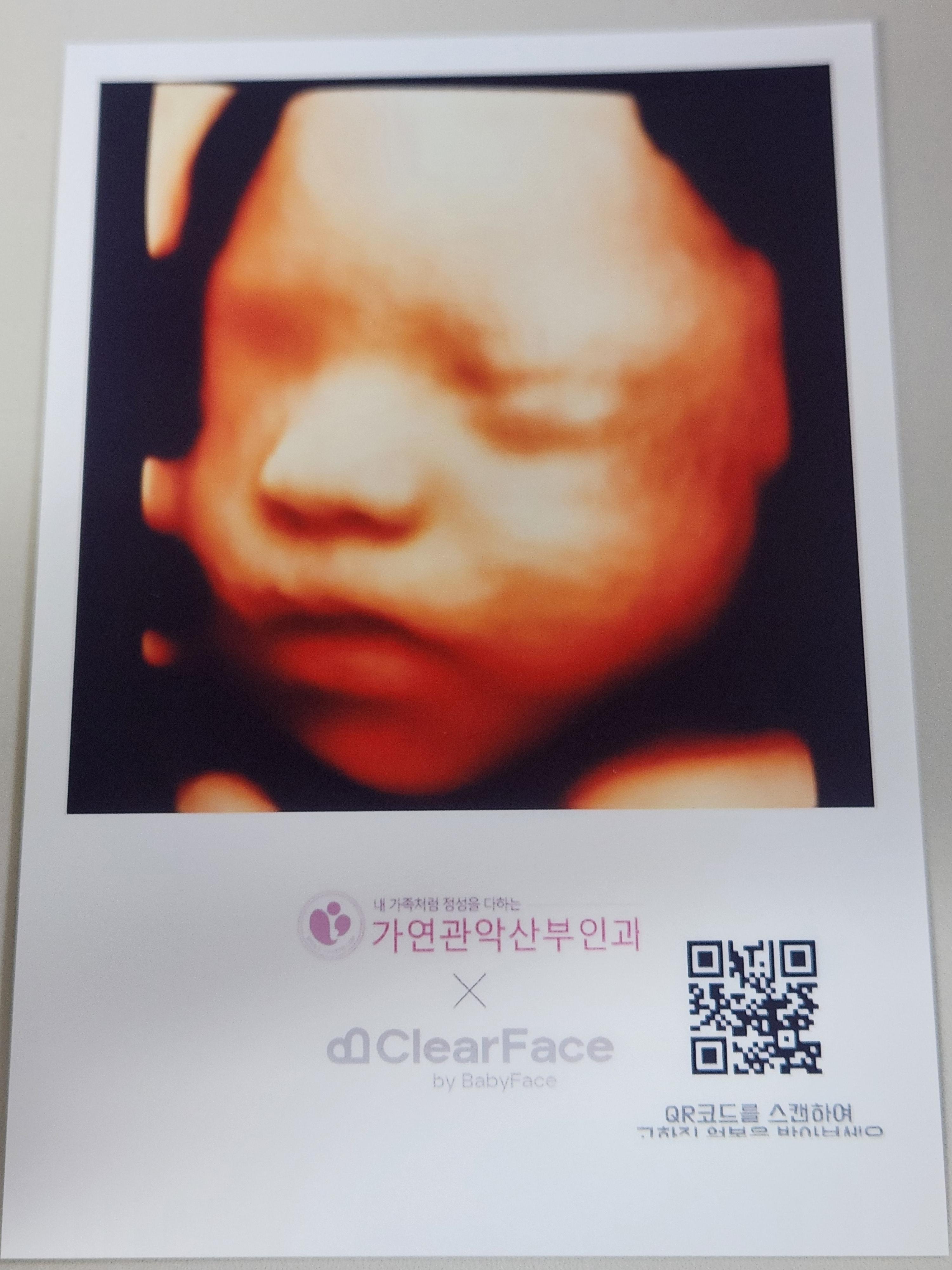 클리어페이스 입체초음파