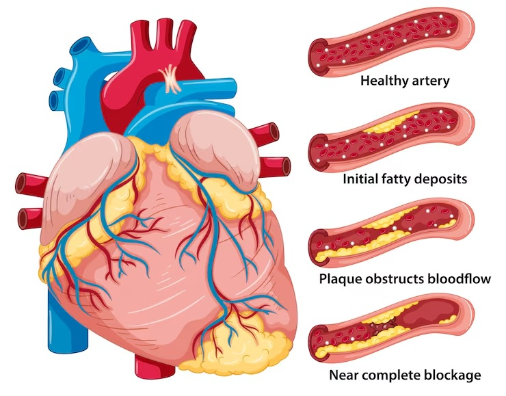 동맥경화증 초기증상 원인