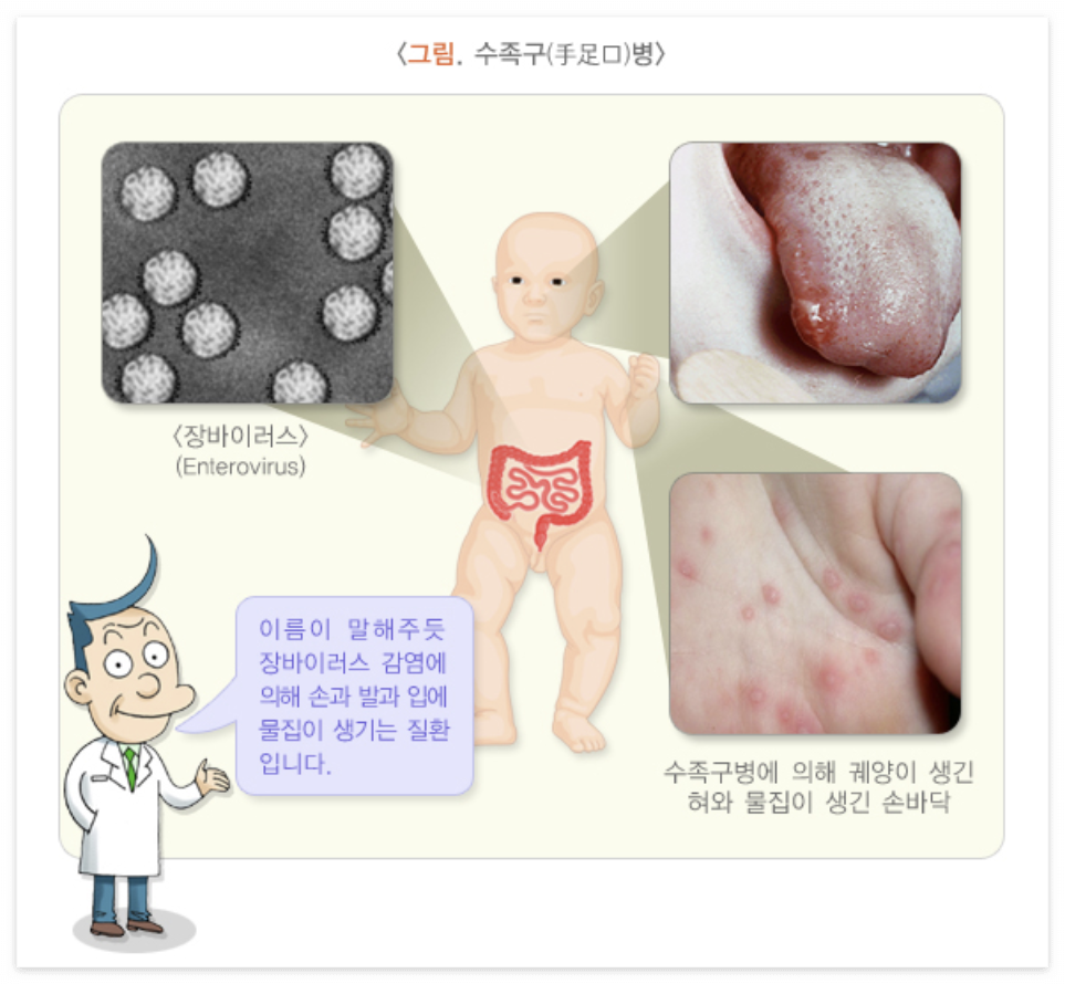수족구병 증상 및 치료방법 알아보기