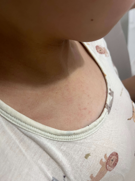 보건소 아토피사업 신청방법