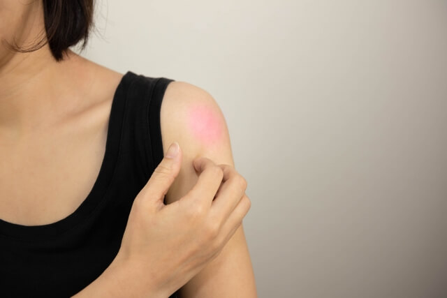 아토피피부염의 근본 원인과 효과적인 치료 방법