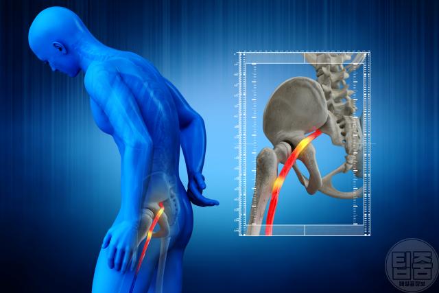 골반통증 원인 좌골신경통 증상 허리통증
