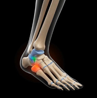 발목 관절염 초기 증상 체크15