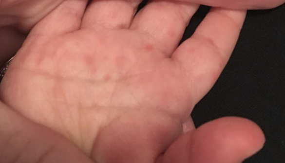 수족구 수포 - 작은 물집 하나에 무너진 엄마의 하루