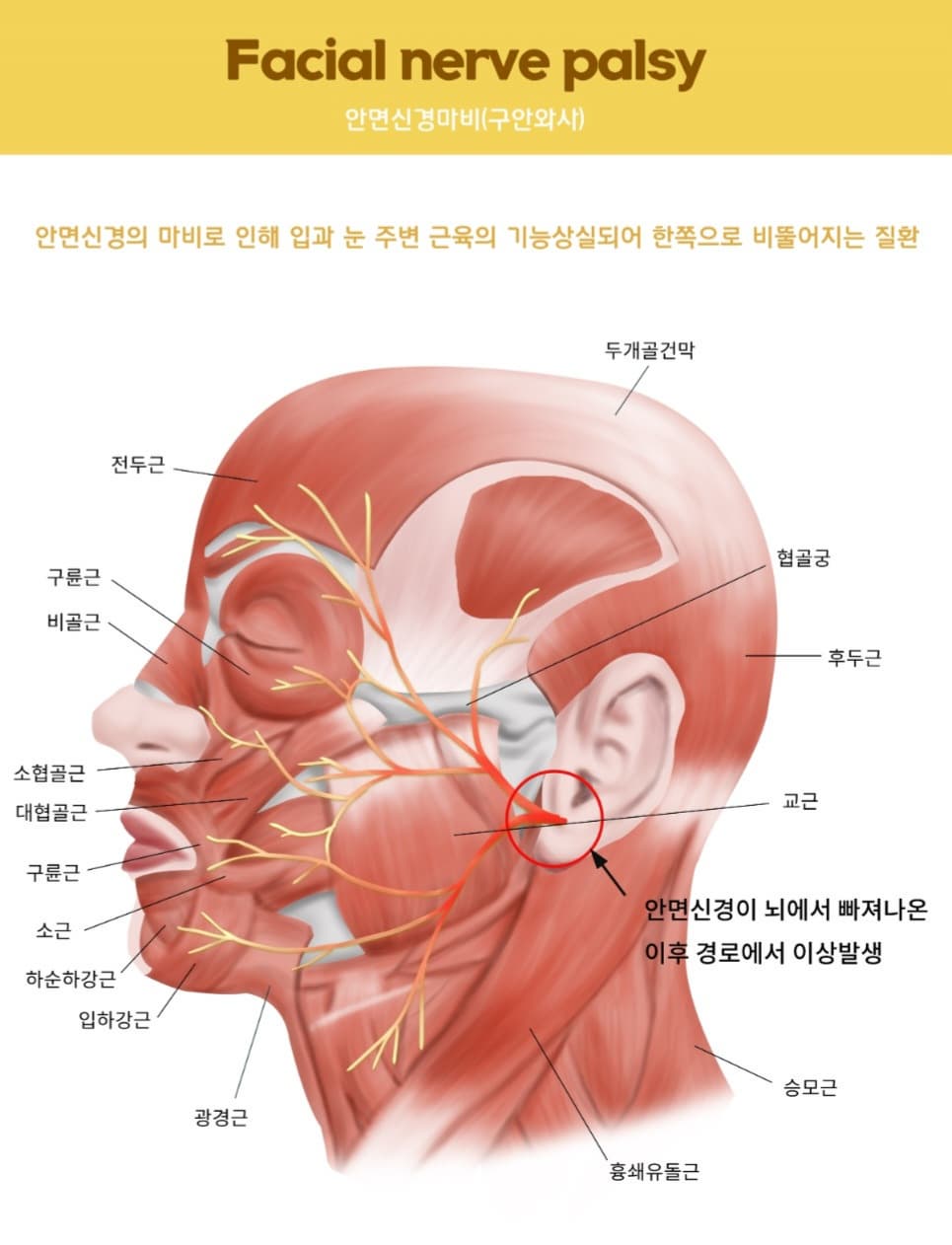 구안와사 증상