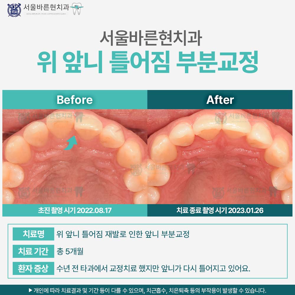 해운대부분교정