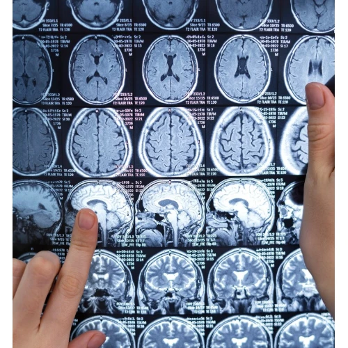 포스파티딜세린의 효능과 부작용 - 치매 예방에 도움될까?