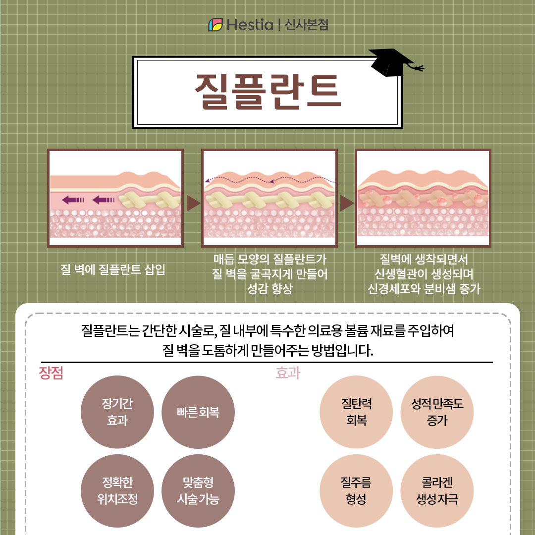 질플란트는 어떤 방법인가요?