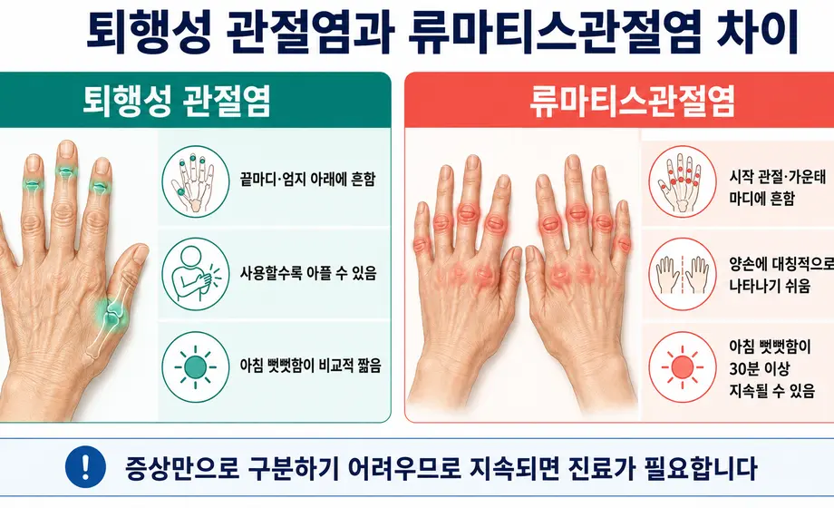 손가락 퇴행성 관절염과 류마티스관절염의 통증 부위와 증상 차이