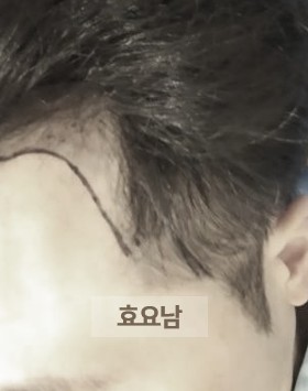모발이식 가이드-우