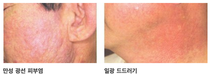햇빛-알레르기-종류