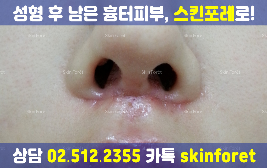 코성형 전후, 비주 부위 흉터와 수술 흔적