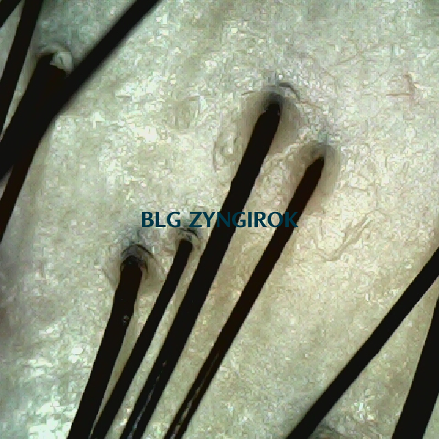 피나모아 복용 10주차 두피사진 - 정수리 위치 모습이다.