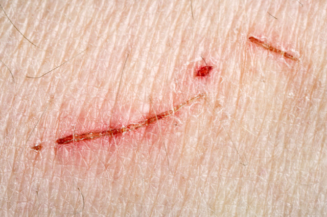 당뇨병 초기증상