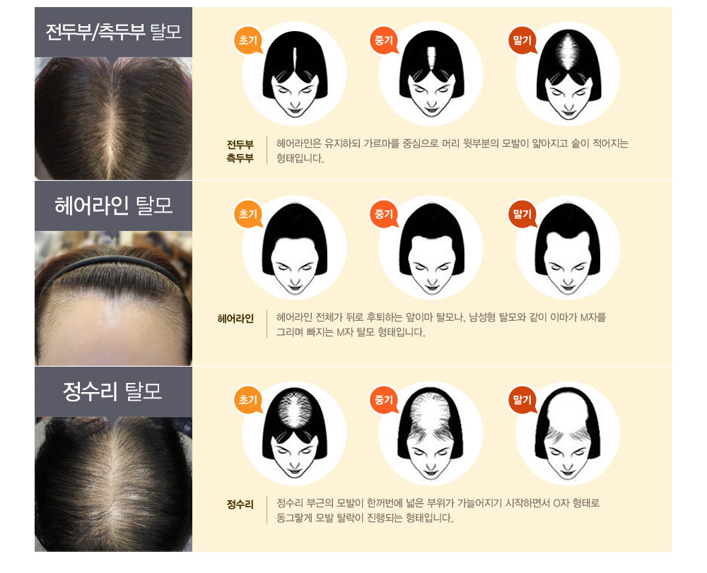 여자- 정수리- 탈모 -증상