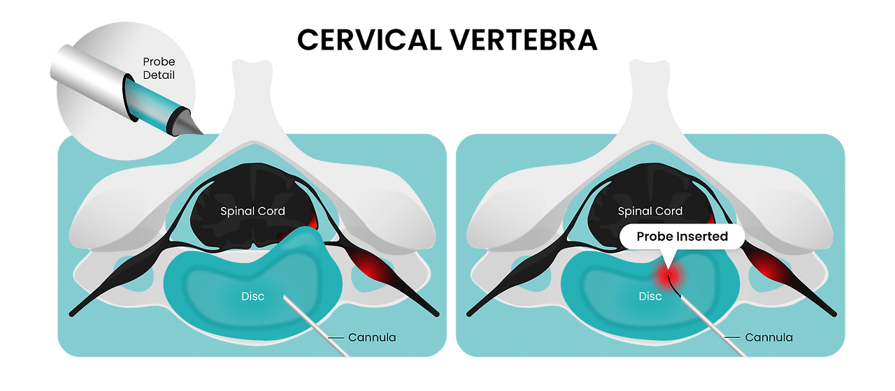 목디스크 치료방법