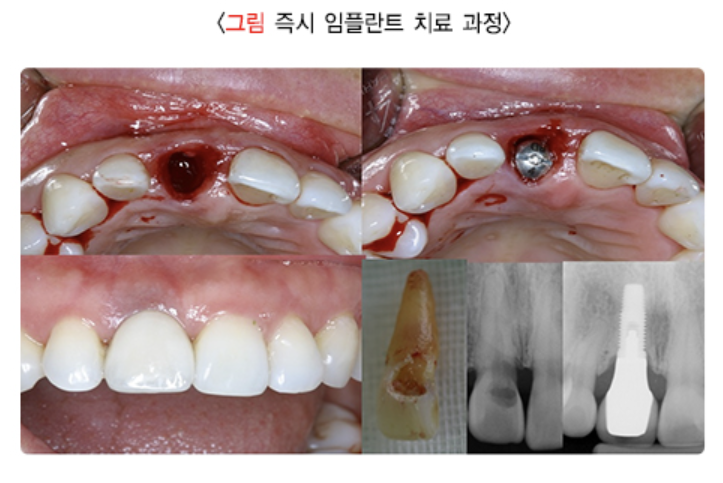 즉시 임플란트