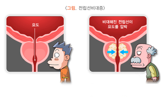 전립선 비대증