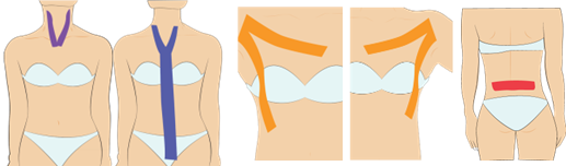 인후의 자극, 건조한 공기, 감기, 기관지염, 역류성 식도염의 테이핑요법