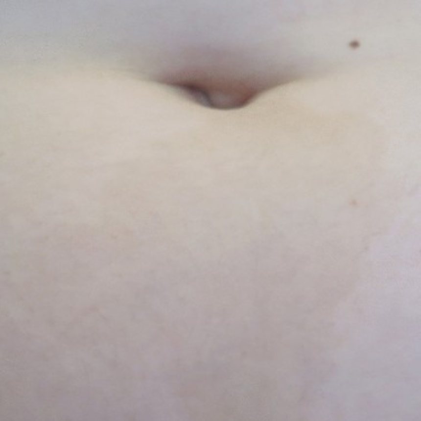 신경섬유종 초기 증상, 혹시 나도? 놓치면 안 되는 신호