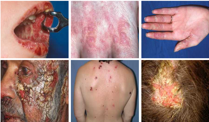 구강, 손등, 손바닥, 얼굴, 몸통, 두피에 나타난 6명의 PNP환자들의 다양한 증상들