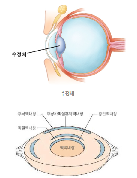 백내장의 종류