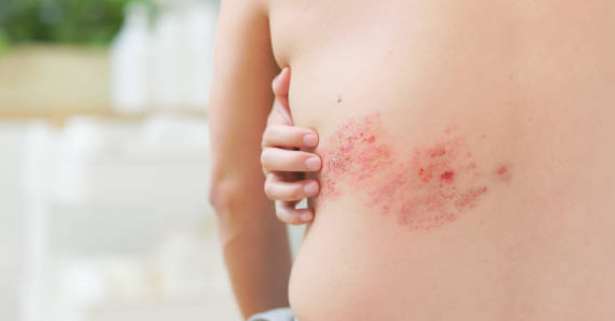 대상포진 증상, 전염, 치료방법 총정리 (2024ver)