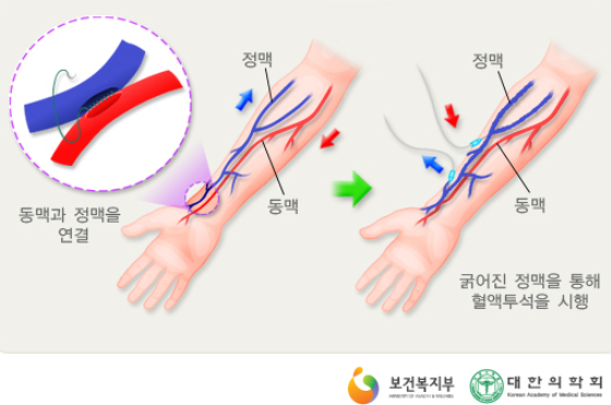 혈액투석 환자의 혈관관리 방법과 중요성