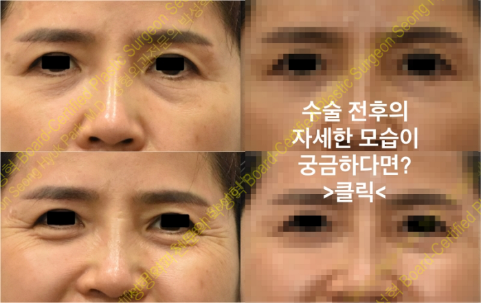 하안검