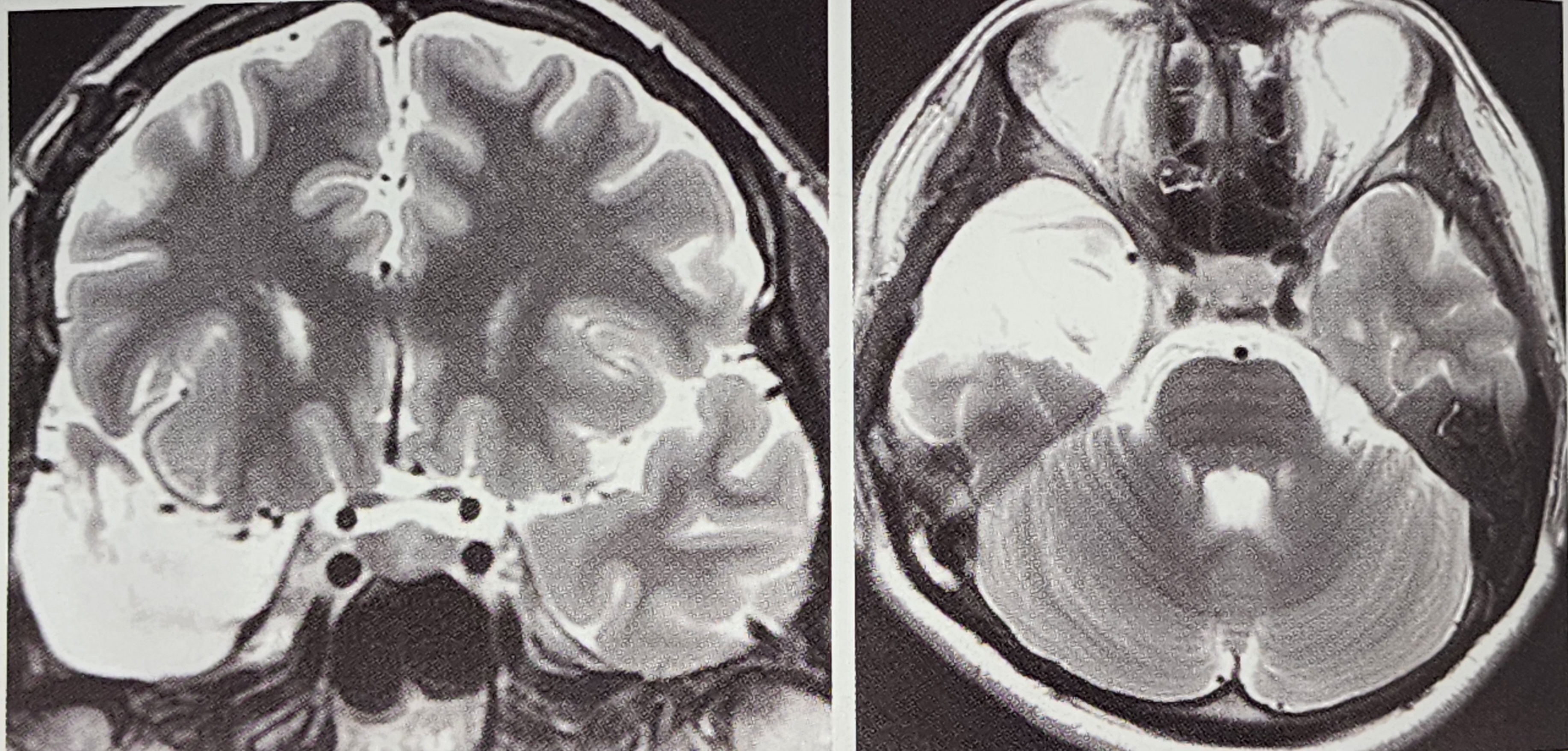 측두엽 뇌전증과 측두엽 절제술