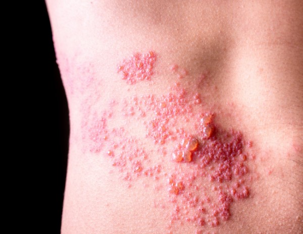 대상포진 초기증상