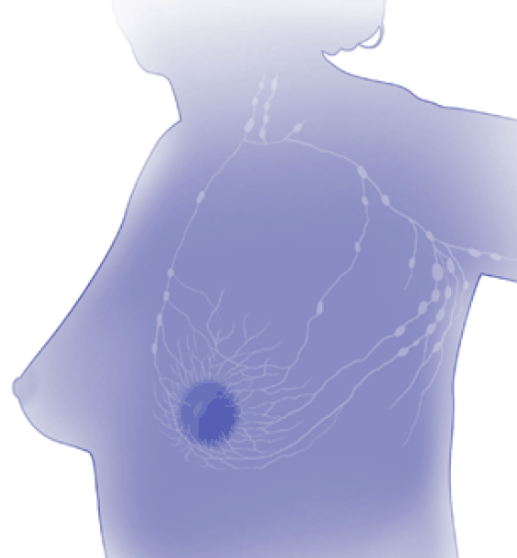 임파선암-악성림프종