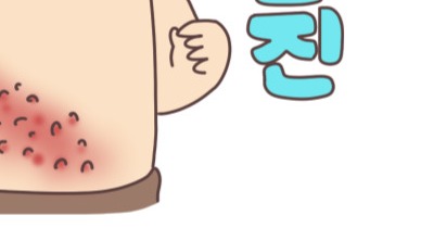 대상포진 초기증상