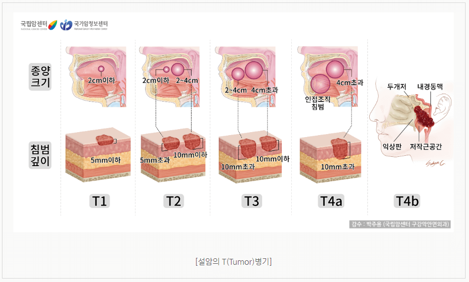 설암 침샘암 편도암 초기증상