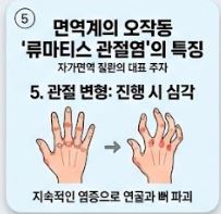 류마티스 관절염 초기증상