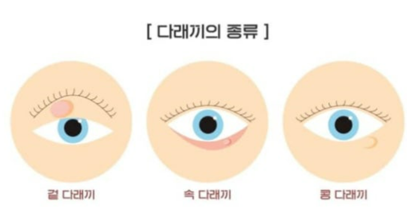 다래끼의- 종류