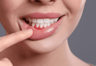 잇몸 염증 치료약