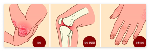 건선