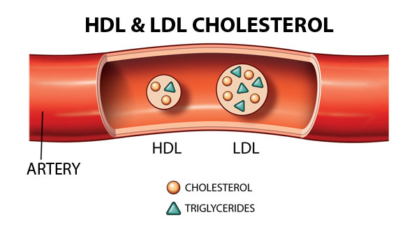 콜레스테롤 HDL과 LDL, 그리고 그 안에 든 중성지방을 그린 그림