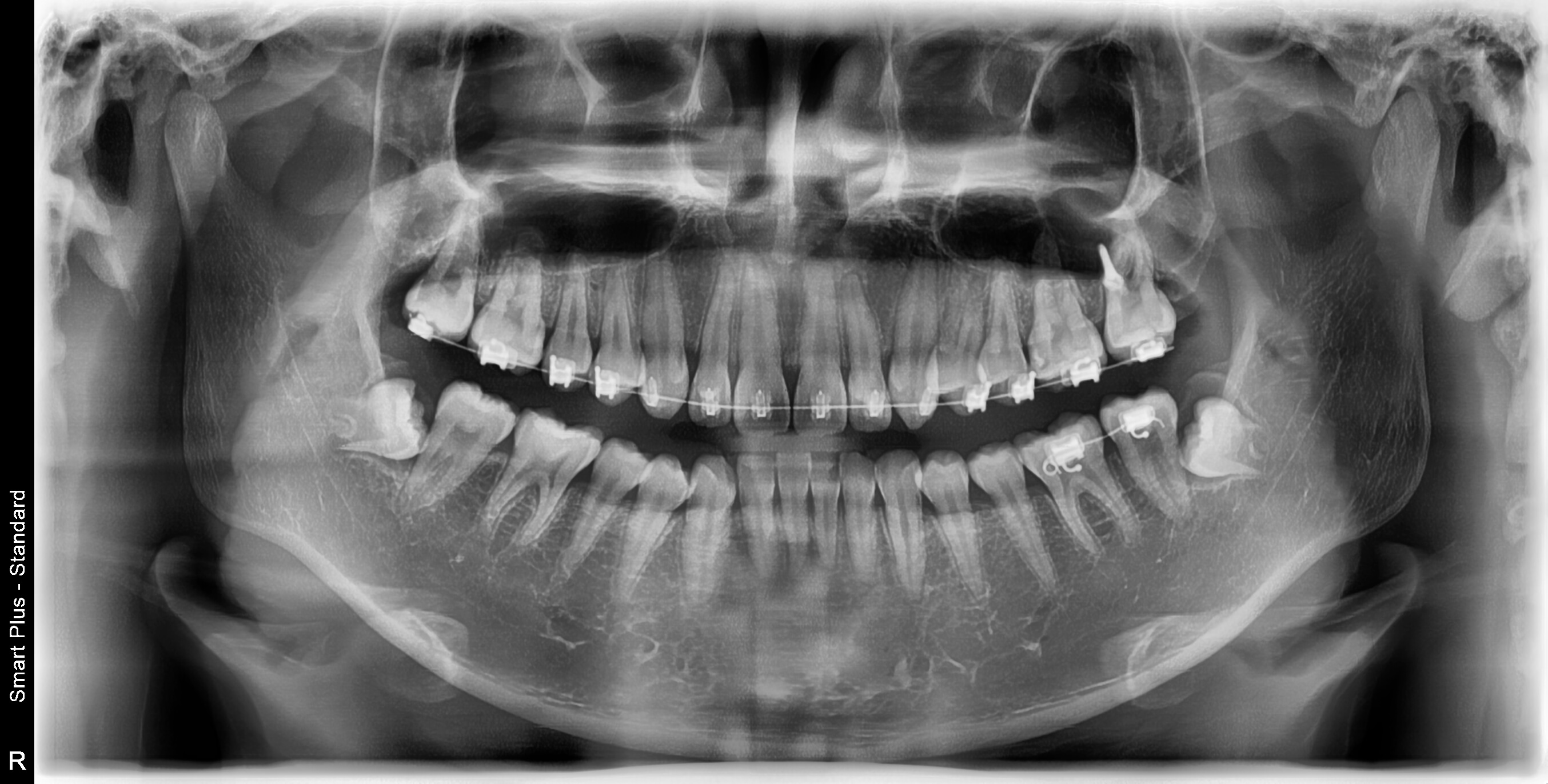 부정교합 가위교합 과개교합 치아교정 후기22